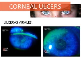 CORNEAL ULCERS
ULCERAS VIRALES:
 