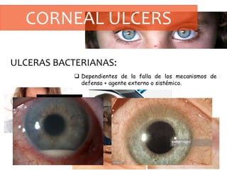 CORNEAL ULCERS
ULCERAS BACTERIANAS:
 Dependientes de la falla de los mecanismos de
defensa + agente externo o sistémico.
 