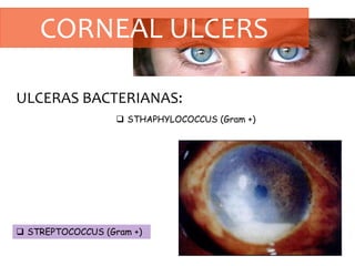 CORNEAL ULCERS
ULCERAS BACTERIANAS:
 STHAPHYLOCOCCUS (Gram +)
 STREPTOCOCCUS (Gram +)
 