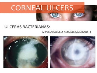 CORNEAL ULCERS
ULCERAS BACTERIANAS:
 PSEUDOMONA AERUGINOSA (Gram -)
 