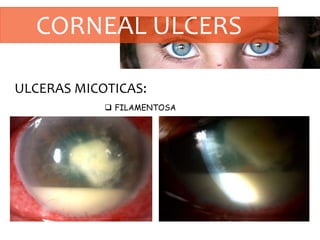 CORNEAL ULCERS
ULCERAS MICOTICAS:
 FILAMENTOSA
 