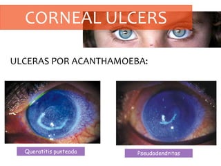 CORNEAL ULCERS
ULCERAS POR ACANTHAMOEBA:
Queratitis punteada Pseudodendritas
 