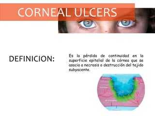 CORNEAL ULCERS
DEFINICION:
Es la pérdida de continuidad en la
superficie epitelial de la córnea que se
asocia a necrosis o destrucción del tejido
subyacente.
 