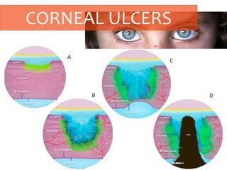 CORNEAL ULCERS
A
B
C
D
 