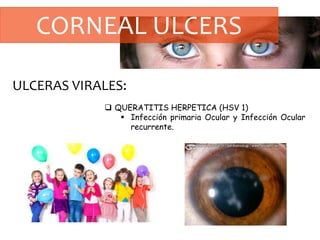 CORNEAL ULCERS
ULCERAS VIRALES:
 QUERATITIS HERPETICA (HSV 1)
 Infección primaria Ocular y Infección Ocular
recurrente.
 