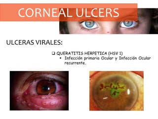 CORNEAL ULCERS
ULCERAS VIRALES:
 QUERATITIS HERPETICA (HSV 1)
 Infección primaria Ocular y Infección Ocular
recurrente.
 