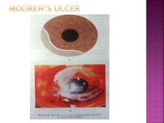 Corneal ulcers