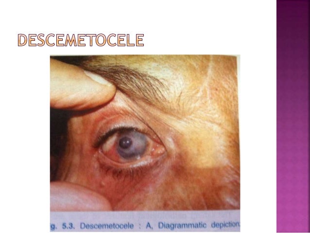 Corneal ulcers