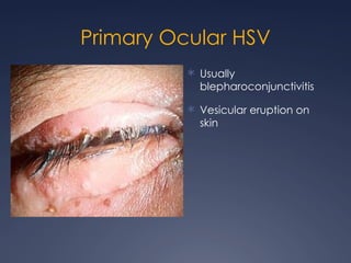 Cornea presentation including infectious disease | PPTX