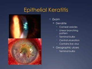 Cornea presentation including infectious disease | PPTX