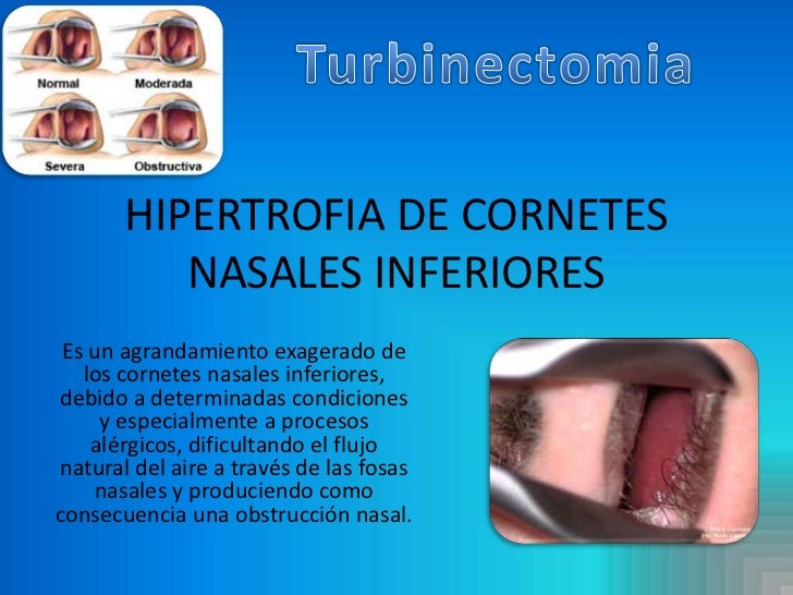 nasales inferiores[1]