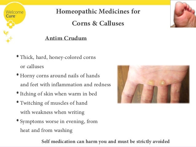 corn foot treatment homeopathic