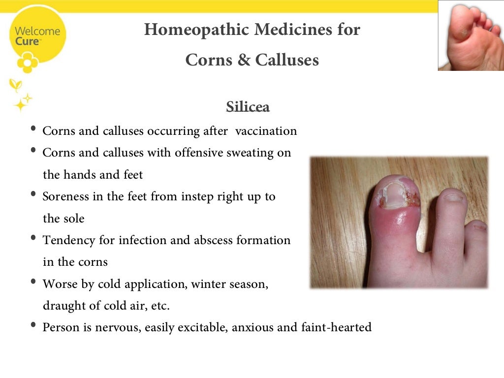 Are Corns Leaving You Sore? Then Its Time To Go For Homeopathy!