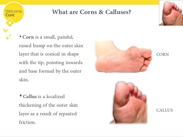 homeopathic treatment for corns on feet