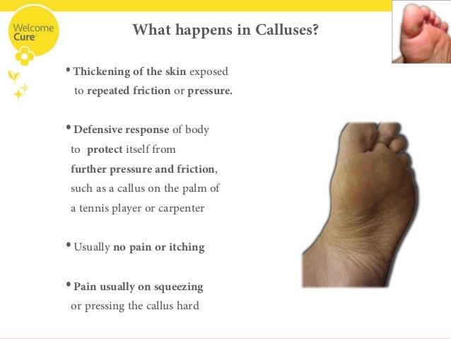 homeopathic medicine for corns on soles