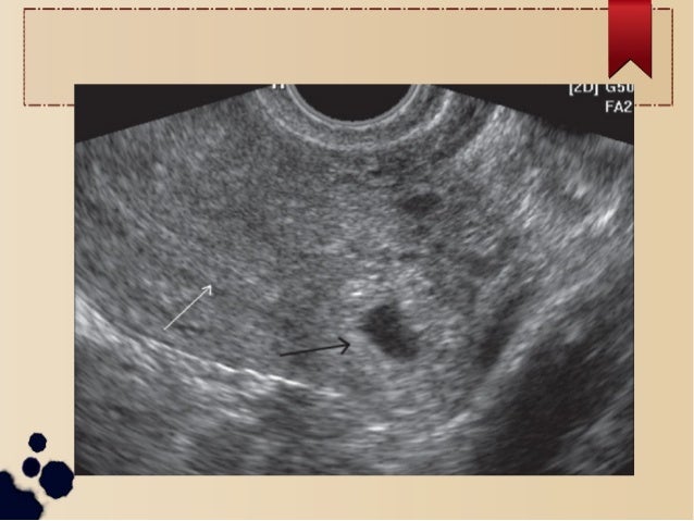Cornual ectopic case series