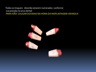 Todos os troqueis deverão estarem numerados conforme
sua posição no arco dental
PARA NÃO CAUSAR DÚVIDAS NA HORA DA INSPLINTAGEM EM BOCA
 