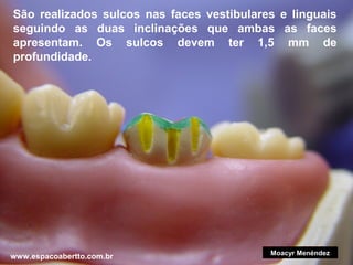São realizados sulcos nas faces vestibulares e linguais
seguindo as duas inclinações que ambas as faces
apresentam. Os sulcos devem ter 1,5 mm de
profundidade.

www.espacoabertto.com.br

Moacyr Menéndez

 