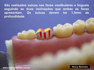 São realizados sulcos nas faces vestibulares e linguais
seguindo as duas inclinações que ambas as faces
apresentam. Os sulcos devem ter 1,5mm de
profundidade.

www.espacoabertto.com.br

Moacyr Menéndez

 