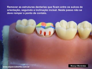 Remover as estruturas dentarias que ficam entre os sulcos de
orientação, seguindo a inclinação incisal. Neste passo não se
deve romper o ponto de contato.

www.espacoabertto.com.br

Moacyr Menéndez

 