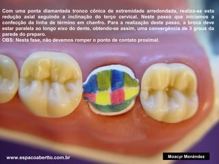 Com uma ponta diamantada tronco cônica de extremidade arredondada, realiza-se esta
redução axial seguindo a inclinação do terço cervical. Neste passo que iniciamos a
confecção da linha de término em chanfro. Para a realização deste passo, a broca deve
estar paralela ao longo eixo do dente, obtendo-se assim, uma convergência de 3 graus da
parede do preparo.
OBS: Nesta fase, não devemos romper o ponto de contato proximal.

www.espacoabertto.com.br

Moacyr Menéndez

 