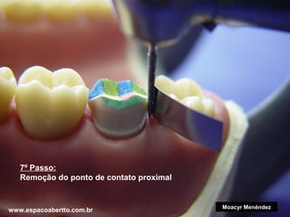 7º Passo:
Remoção do ponto de contato proximal

www.espacoabertto.com.br

Moacyr Menéndez

 