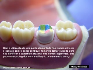 Com a utilização de uma ponta diamantada fina, vamos eliminar
o contato com o dente contíguo, tomando tomar cuidado para
não danificar a superfície proximal dos dentes adjacentes, que
podem ser protegidos com a utilização de uma matriz de aço.

www.espacoabertto.com.br

Moacyr Menéndez

 