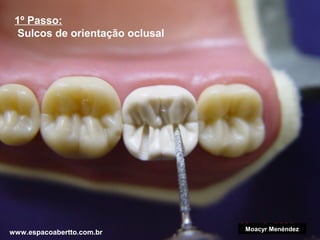 1º Passo:
Sulcos de orientação oclusal

www.espacoabertto.com.br

Moacyr Menéndez

 