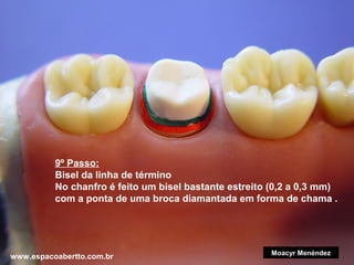 9º Passo:
Bisel da linha de término
No chanfro é feito um bisel bastante estreito (0,2 a 0,3 mm)
com a ponta de uma broca diamantada em forma de chama .

www.espacoabertto.com.br

Moacyr Menéndez

 