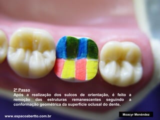 2º Passo
Após a realização dos sulcos de orientação, é feito a
remoção das estruturas remanescentes seguindo a
conformação geométrica da superfície oclusal do dente.
www.espacoabertto.com.br

Moacyr Menéndez

 