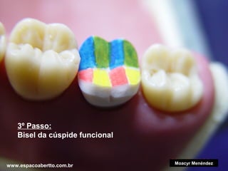 3º Passo:
Bisel da cúspide funcional

www.espacoabertto.com.br

Moacyr Menéndez

 