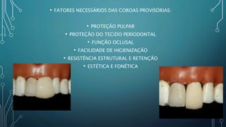 • FATORES NECESSÁRIOS DAS COROAS PROVISÓRIAS:
• PROTEÇÃO PULPAR
• PROTEÇÃO DO TECIDO PERIODONTAL
• FUNÇÃO OCLUSAL
• FACILIDADE DE HIGIENIZAÇÃO
• RESISTÊNCIA ESTRUTURAL E RETENÇÃO
• ESTÉTICA E FONÉTICA
 