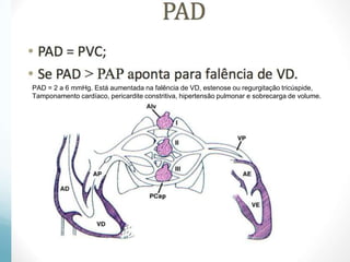 PAD = 2 a 6 mmHg. Está aumentada na falência de VD, estenose ou regurgitação tricúspide,
Tamponamento cardíaco, pericardite constritiva, hipertensão pulmonar e sobrecarga de volume.
 