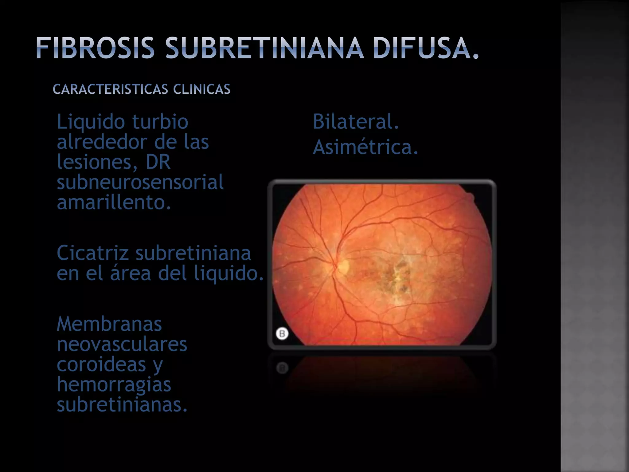 Coroiditis multifocal con_panuveitis | PPTX