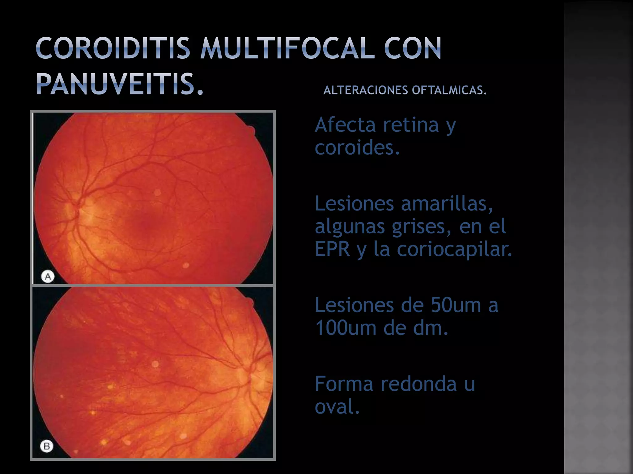 Coroiditis multifocal con_panuveitis | PPTX