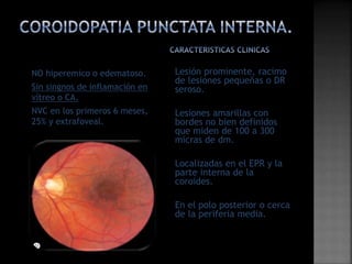 Coroiditis multifocal con_panuveitis | PPTX
