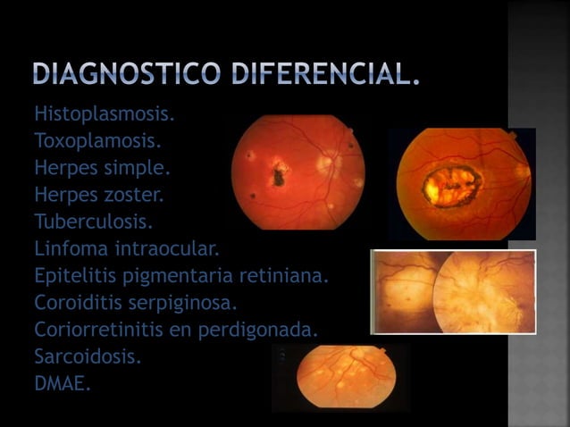 Coroiditis multifocal con_panuveitis | PPTX