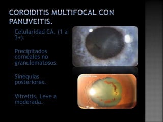 Coroiditis multifocal con_panuveitis | PPTX