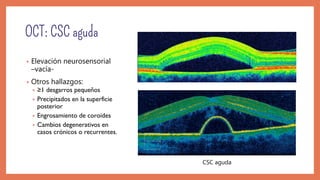 • Elevación neurosensorial
–vacía-
• Otros hallazgos:
• ≥1 desgarros pequeños
• Precipitados en la superficie
posterior
• Engrosamiento de coroides
• Cambios degenerativos en
casos crónicos o recurrentes.
CSC aguda
 