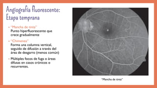 • “Mancha de tinta”
Punto hiperfluorescente que
crece gradualmente
• “Chimenea”
Forma una columna vertical,
seguido de difusión a través del
área de desgarro (menos común)
• Múltiples focos de fuga o áreas
difusas en casos crónicos o
recurrentes.
“Mancha de tinta”
 