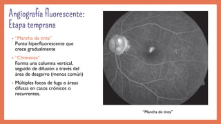 • “Mancha de tinta”
Punto hiperfluorescente que
crece gradualmente
• “Chimenea”
Forma una columna vertical,
seguido de difusión a través del
área de desgarro (menos común)
• Múltiples focos de fuga o áreas
difusas en casos crónicos o
recurrentes.
“Mancha de tinta”
 