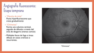 • “Mancha de tinta”
Punto hiperfluorescente que
crece gradualmente
• “Chimenea”
Forma una columna vertical,
seguido de difusión a través del
área de desgarro (menos común)
• Múltiples focos de fuga o áreas
difusas en casos crónicos o
recurrentes.
“Chimenea”
 