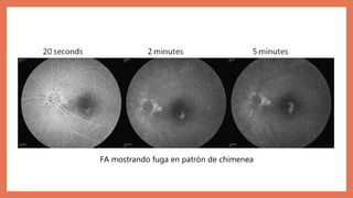 FA mostrando fuga en patrón de chimenea
 