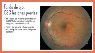 • ≥1 Focos de hiperpigmentación
del EPR de tamaño variable en
desgarro neurosensorial
• Focos de atrofia e hiperplasia
en cualquier otra zona del polo
posterior
 