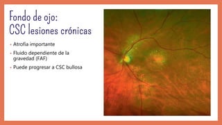 • Atrofia importante
• Fluido dependiente de la
gravedad (FAF)
• Puede progresar a CSC bullosa
 