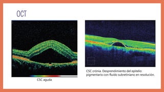 CSC aguda
CSC crónia. Desprendimiento del epitelio
pigmentario con fluido subretiniano en resolución.
 