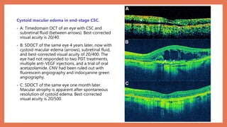 Cystoid macular edema in end-stage CSC.
• A: Timedomain OCT of an eye with CSC and
subretinal fluid (between arrows). Best-corrected
visual acuity is 20/40.
• B: SDOCT of the same eye 4 years later, now with
cystoid macular edema (arrows), subretinal fluid,
and best-corrected visual acuity of 20/400. The
eye had not responded to two PDT treatments,
multiple anti-VEGF injections, and a trial of oral
acetazolamide. CNV had been ruled out with
fluorescein angiography and indocyanine green
angiography.
• C: SDOCT of the same eye one month later.
Macular atrophy is apparent after spontaneous
resolution of cystoid edema. Best-corrected
visual acuity is 20/500.
 