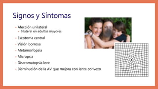 Signos y Síntomas
• Afección unilateral
• Bilateral en adultos mayores
• Escotoma central
• Visión borrosa
• Metamorfopsia
• Micropsia
• Discromatopsia leve
• Disminución de la AV que mejora con lente convexo
 