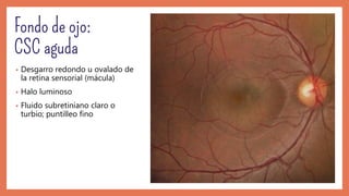 • Desgarro redondo u ovalado de
la retina sensorial (mácula)
• Halo luminoso
• Fluido subretiniano claro o
turbio; puntilleo fino
 