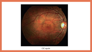 CSC aguda
 